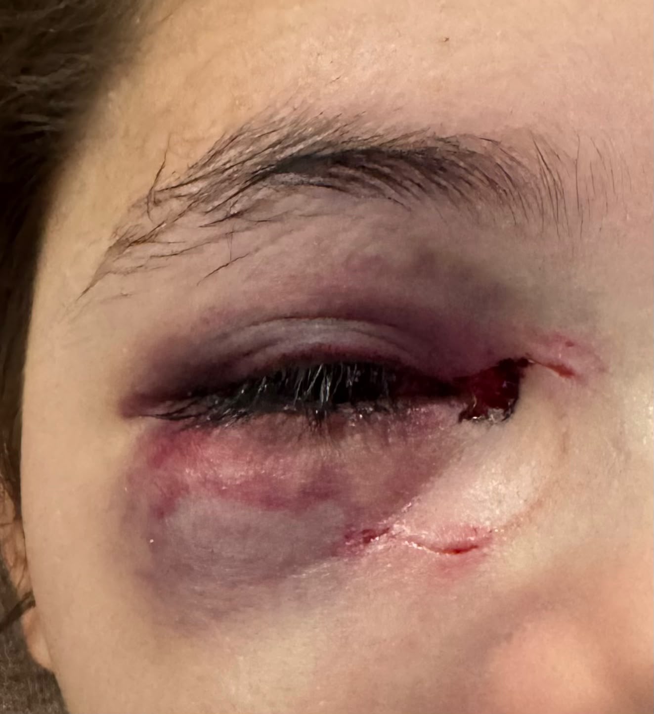 Menina ferida com garrafa em Toledo terá que ficar mais de 30 dias afastada da escola